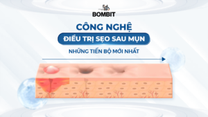 Công nghệ điều trị sẹo sau mụn