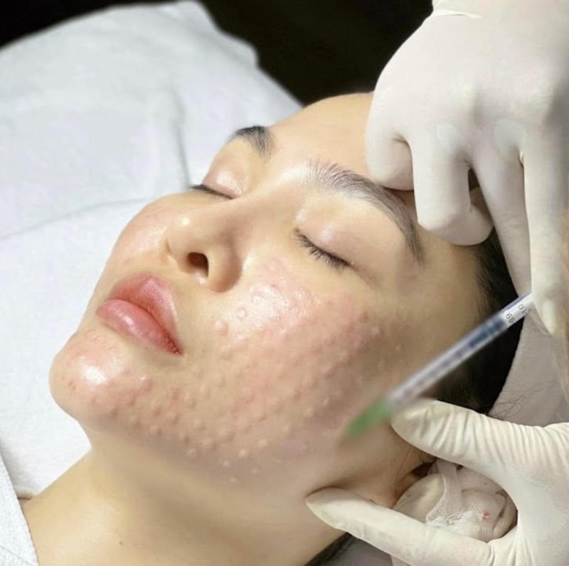 Mesotherapy