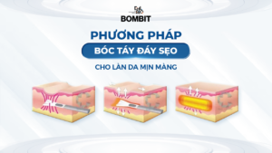 Phương pháp bóc tách đáy sẹo