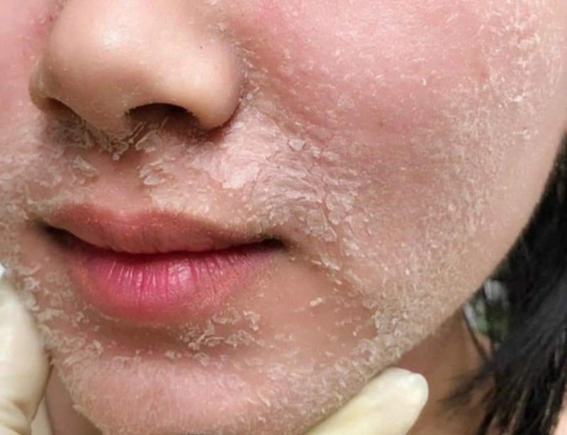 Do sản phẩm peel da kém chất lượng