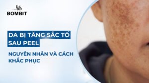 da bị tăng sắc tố sau peel